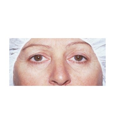 Tear-Trough Correction With Fat Before
